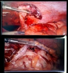 Laparoscopic Appendicectomy