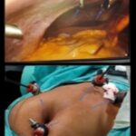 Laparoscopic cholecystectomy showing intra-abdominal laparoscopic view of gallbladder dissection from the liver bed (upper panel) and standard four-port trocar placement on the abdominal wall (lower panel).