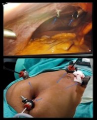 Laparoscopic Operation For Gall bladder Stones