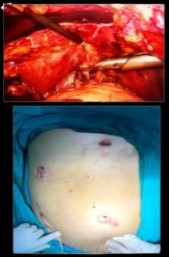 Laparoscopic Completion Cholecystectomy