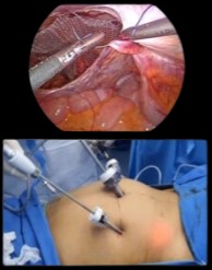 Laparoscopic Operation For Inguinal Hernia