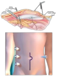 Intra Peritoneal Onlay Mesh Repair)