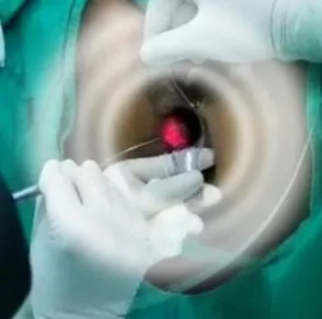 Laser Procedure For Piles (hemorrhoids)