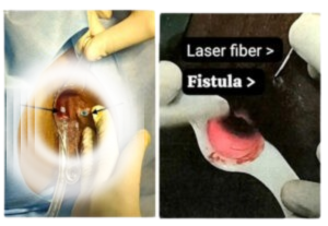 Laser Procedure For Fistula - FiLaC